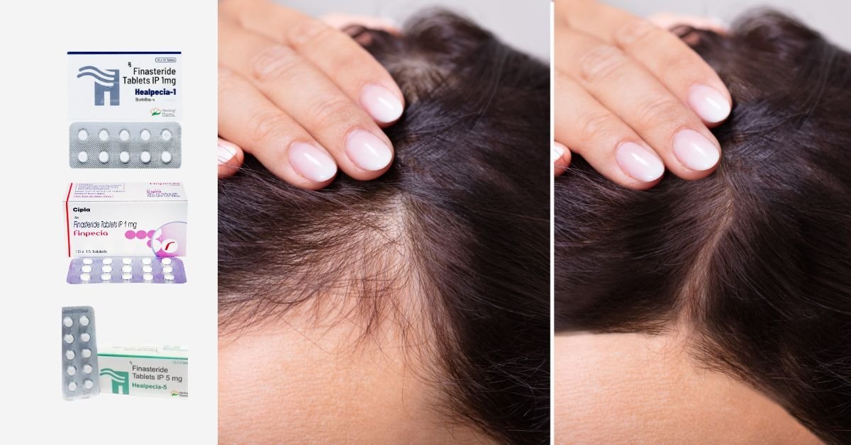 Everything You Should Know Before Taking Finasteride