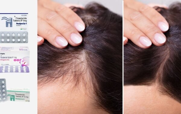 Everything You Should Know Before Taking Finasteride